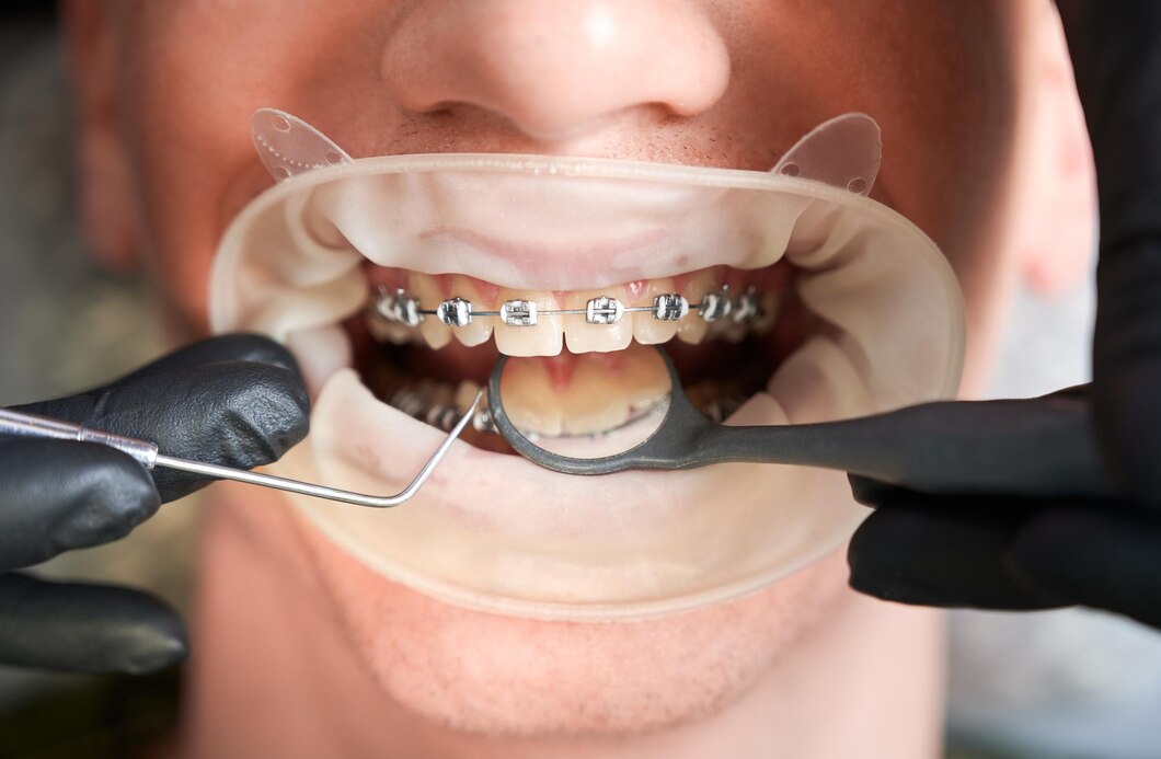 Kiedy może być wskazanane noszenie aparatu ortodontycznego?
